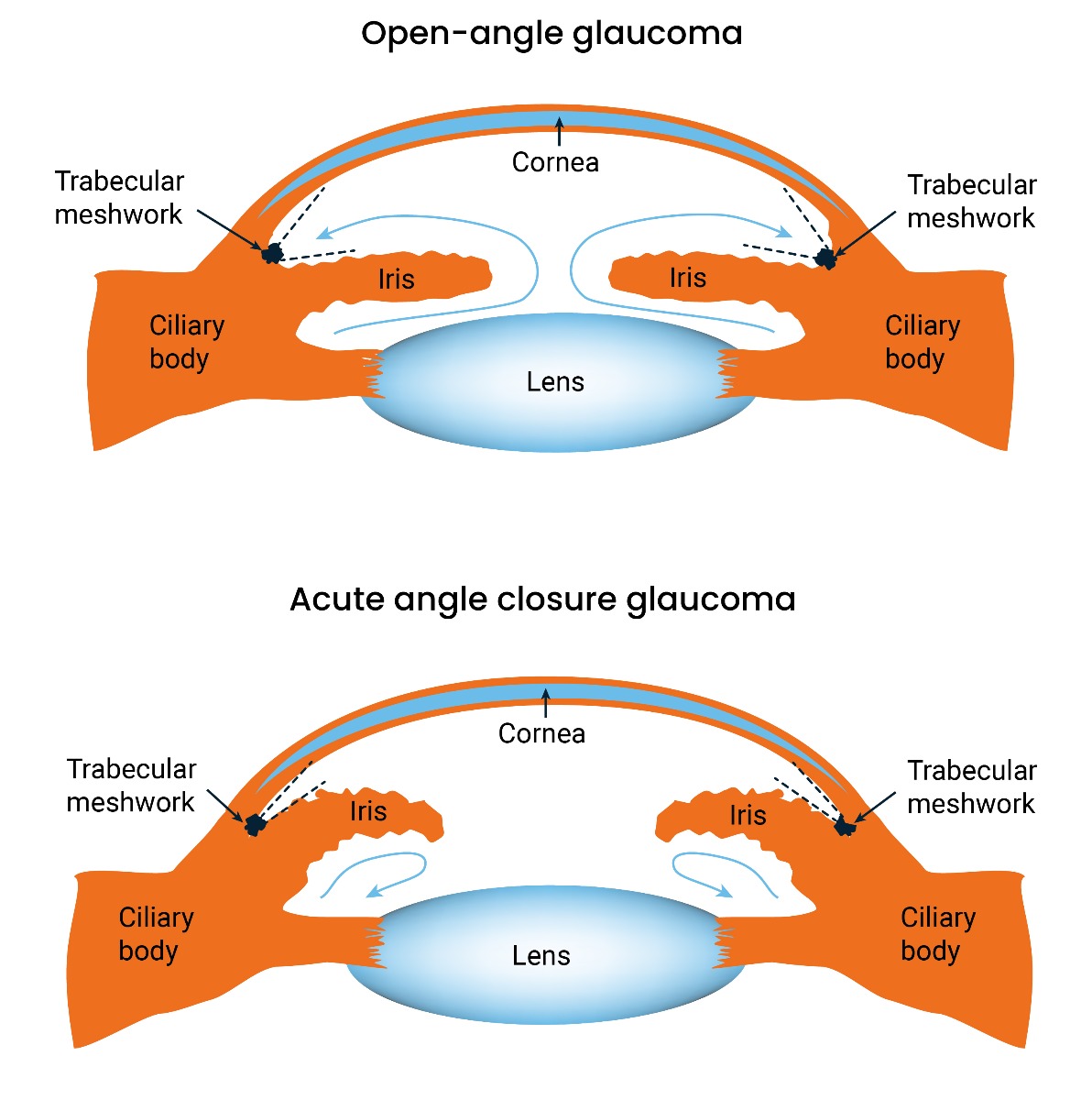 Open angle and acute angle closure glaucoma